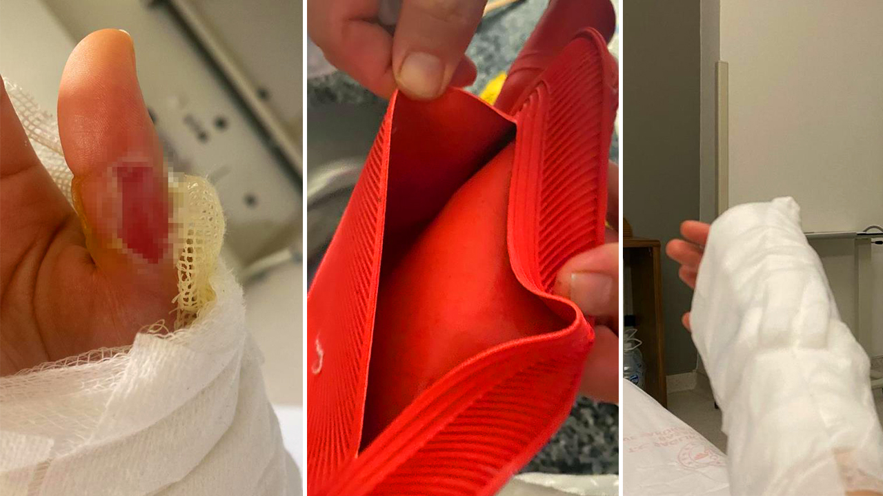 Sıcak su torbası patladı, vücudunun yüzde 25’i yandı